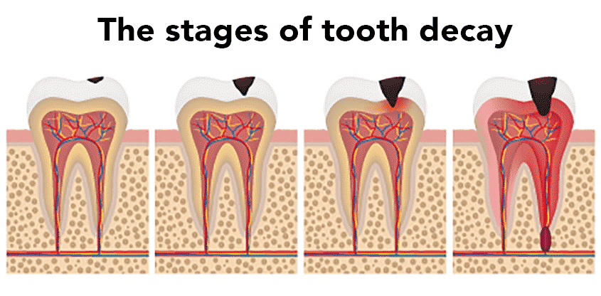Fases van tandverval en ontstaan van gaatjes in het gebit. – Door uw tand of kies tijdig te laten vullen door de tandarts, voorkomt u grotere schade en daarmee gepaarde pijnklachten.
